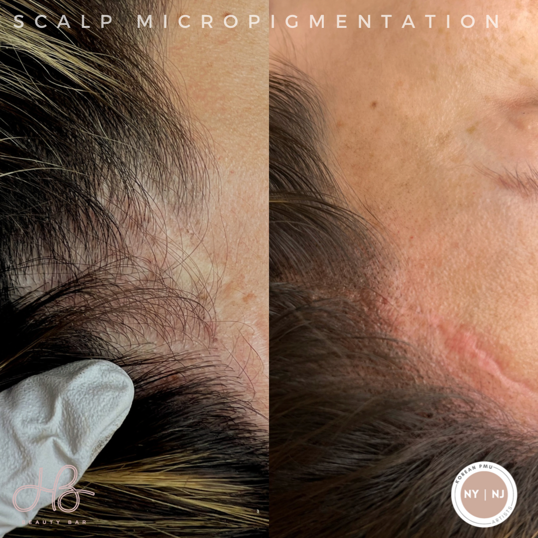 Scalp Micropigmentation (SMP) by Esther